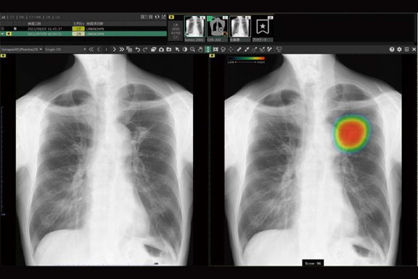 FUJIFILMの胸部レントゲン画像のAI読影支援システムを2025年より導入しました。